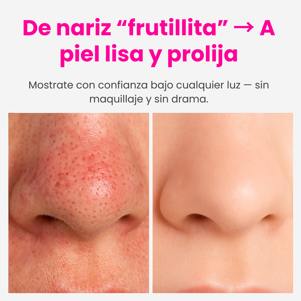 Aqualys™ Quita Puntos Negros con Doble Tanque de Agua